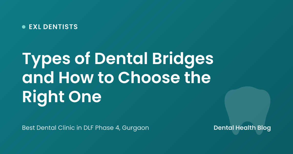 Types of Dental Bridges and How to Choose the Right One