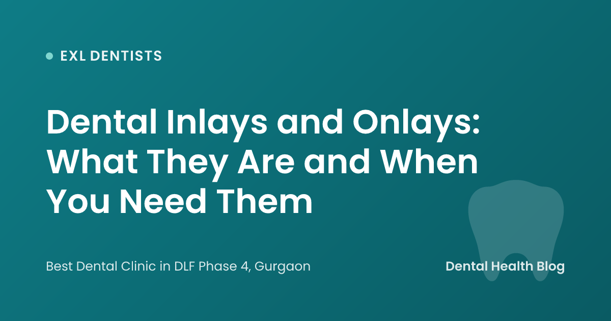 Dental Inlays and Onlays: What They Are and When You Need Them