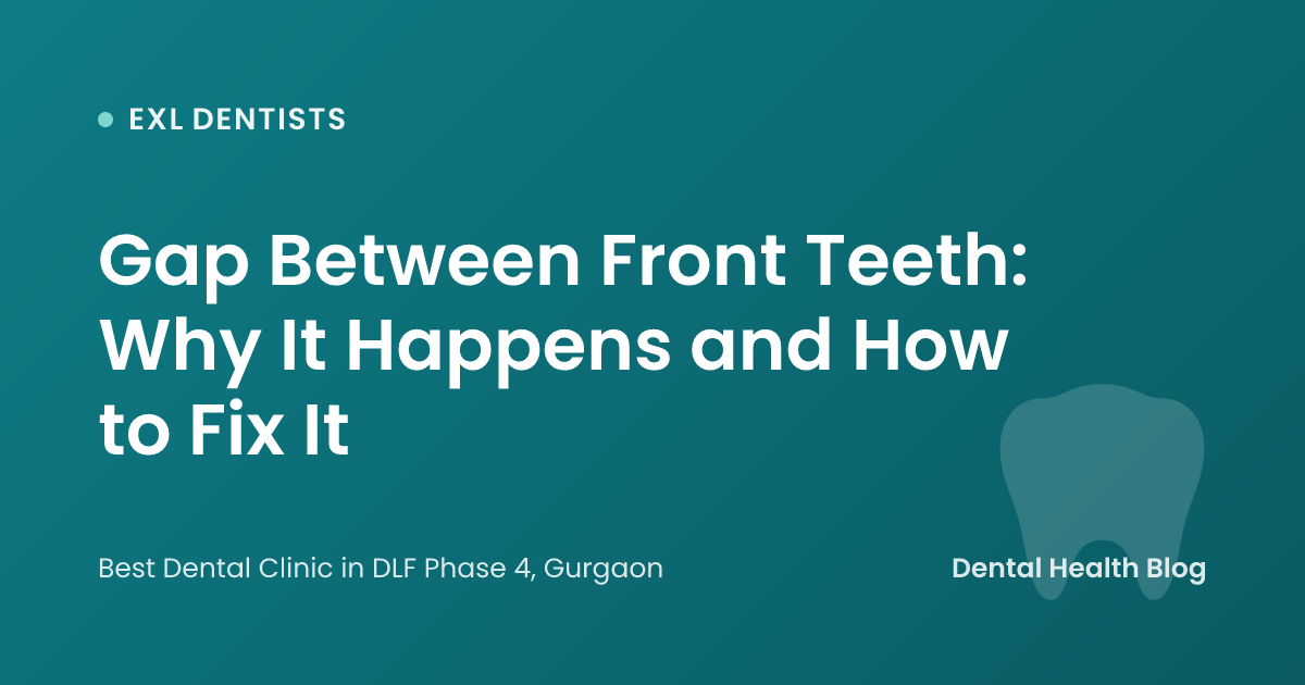 Gap Between Front Teeth: Why It Happens and How to Fix It