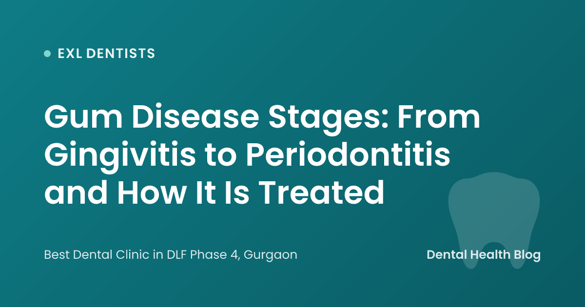 Gum Disease Stages: From Gingivitis to Periodontitis and How It Is Treated
