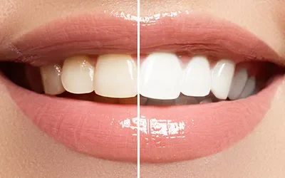 Blogs 3 A Guide to Choosing the Right Dentist for Teeth Whitening in DLF Gurgaon