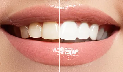 teeth whitening