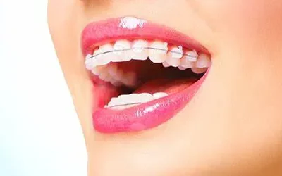 Blogs 3 Brace Yourself: Benefits of Orthodontic Treatment