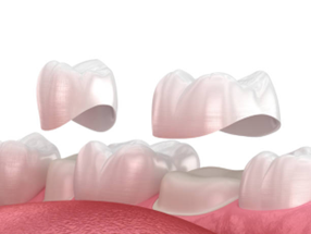 Smile Makeover in Gurgaon 5 crowns and bridges in gurgaon