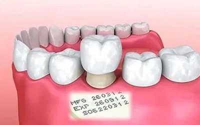 Blogs 7 Does Your Dental Crown Comes with An Expiry Date?