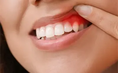 gum treatment in gurgaon Gum Treatment