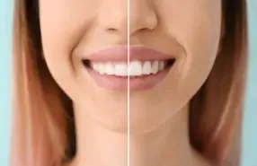Smile Makeover in Gurgaon 7 gum contouring in gurgaon