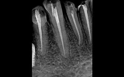 Blogs 4 Is The Root Canal Treatment Painful: Let’s Take The Pain Out Of It