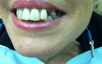 Blogs 8 Missing teeth? Why Replace it?