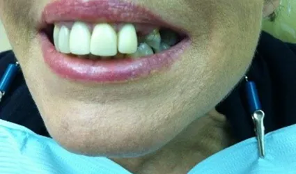 Missing Teeth