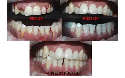 Blogs 5 Scaling And Polishing : What to Expect (From Us)