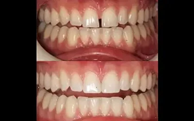 Blogs 1 The Beauty of Direct Dental Veneers