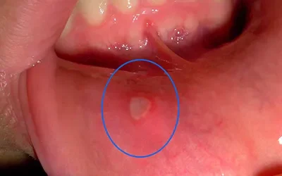 Blogs 6 The Painful Truth: Understanding Oral Ulcers