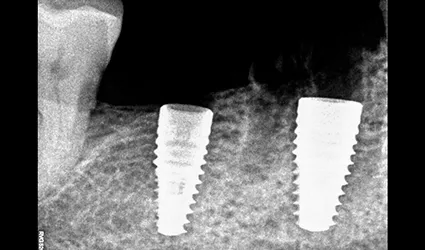 Dental-Implants