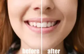 Smile Makeover in Gurgaon 8 tooth reshaping in gurgaon