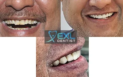 Blogs 10 Transforming Smiles: The Marvels of Dental Smile Makeovers