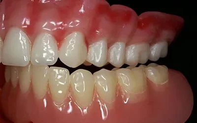 Blogs 6 Unhappy With Your Denture…The Solution Is Simple (And It’s Not Always IMPLANTS)