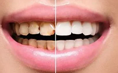 Blogs 6 What To Expect During Laser Teeth Whitening at EXL Dentist
