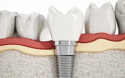 Blogs 7 When Dental Implants are NOT An Option?