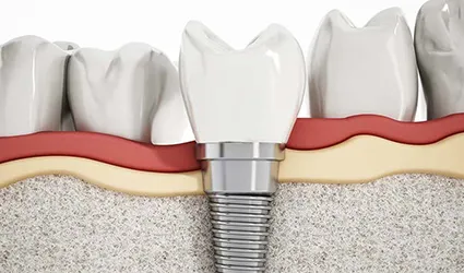 Dental-Implants