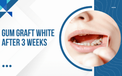 Blogs 3 Gum graft white after 3 weeks