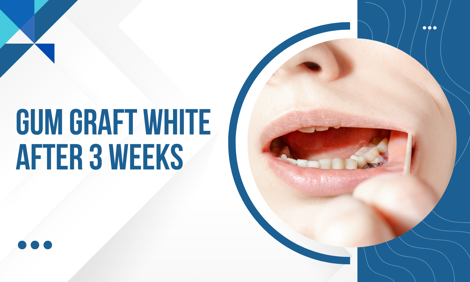 Teeth Whitening Results After 3 Weeks Gurgaon