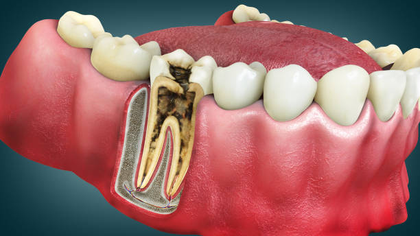Picture1 What Are Invisible Aligners?