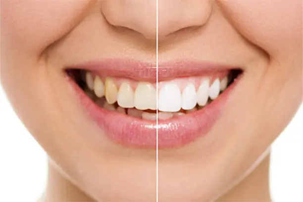 dental implants in dlf phase 1 dental-implants