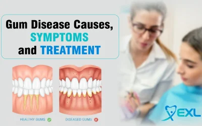 Blogs 4 Gum Disease Causes, Symptoms, and Treatment