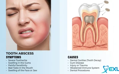 Home 14 Tooth abscess – Symptoms & causes