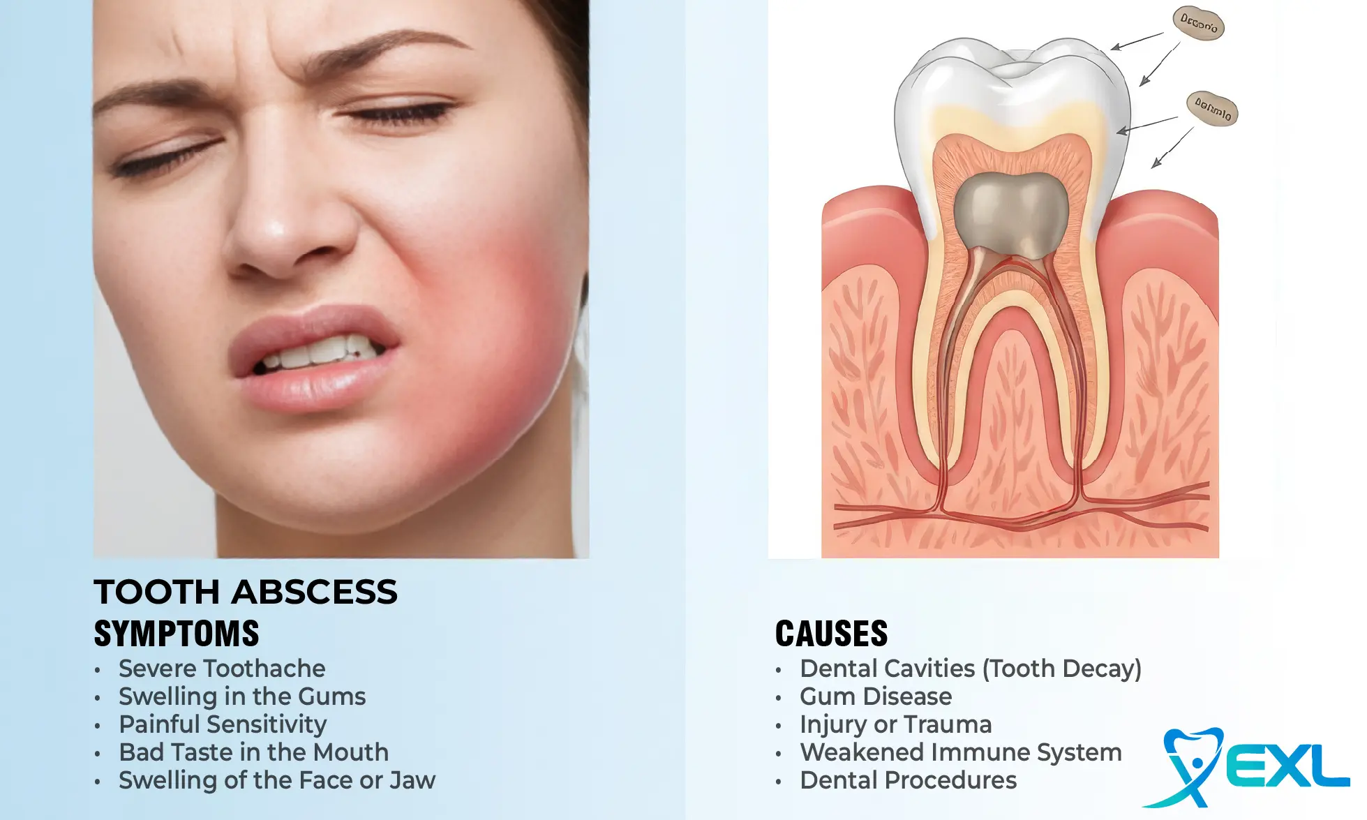 tooth abscess symptoms