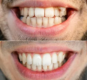 Braces