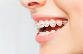 Braces or clear aligners