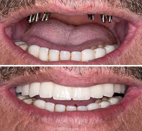 Full mouth implant