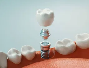 Dental bonding