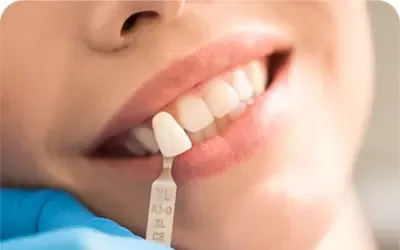 Teeth Whitening