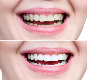 Teeth whitening