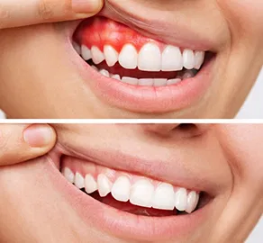 Gum treatment