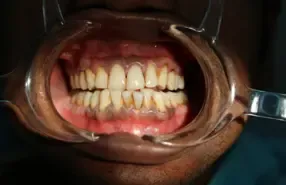 Gum Depigmentation