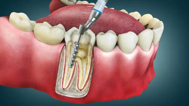 Our Holistic Approach to Root Canal Treatment
