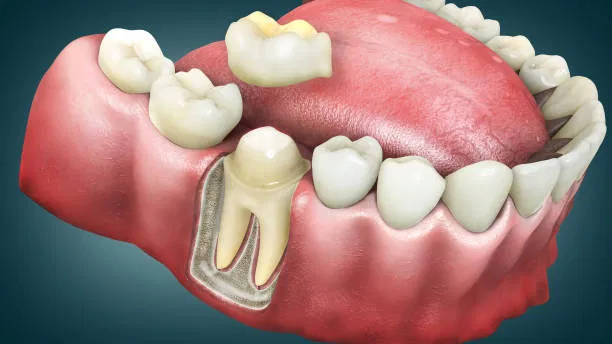 Our Holistic Approach to Root Canal Treatment