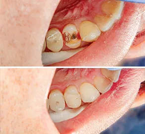 Tooth filling