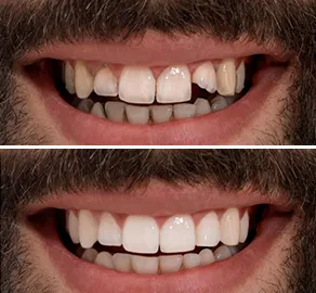 Dental bonding for cracked tooth