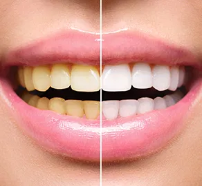  Teeth whitening