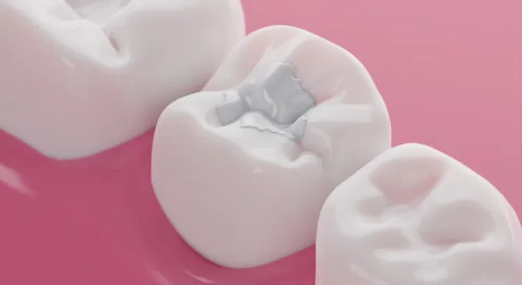Tooth-colored fillings