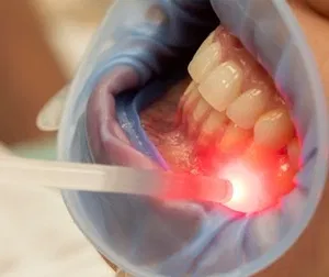 Laser gum therapy