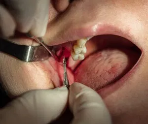 Gum grafting