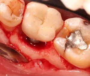Flap surgery (Gingival surgery)