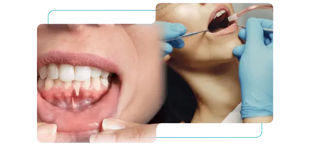gum treatment in gurgaon