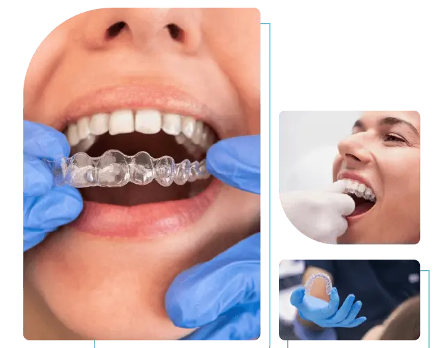 Invisible Aligners